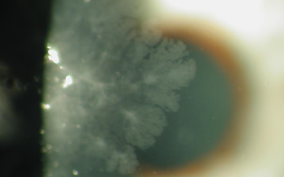 Ophthalmology Case Reports International Ophthalmology Portal